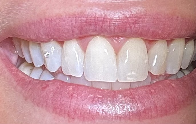 Smile with a professionally applied tooth gem
